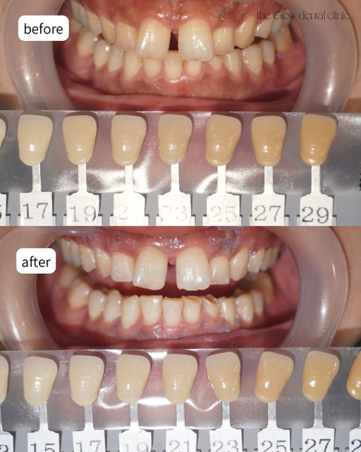 トランセントフラッシュ3回券症例➁