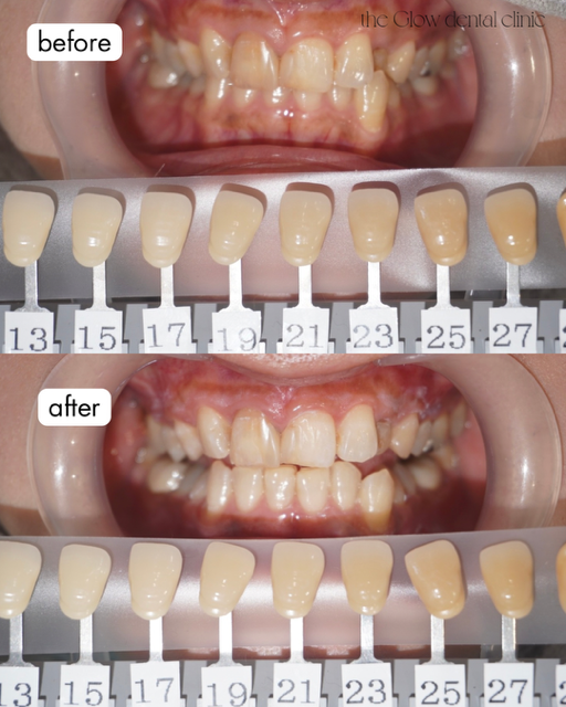 トランセントフラッシュ3回券症例③