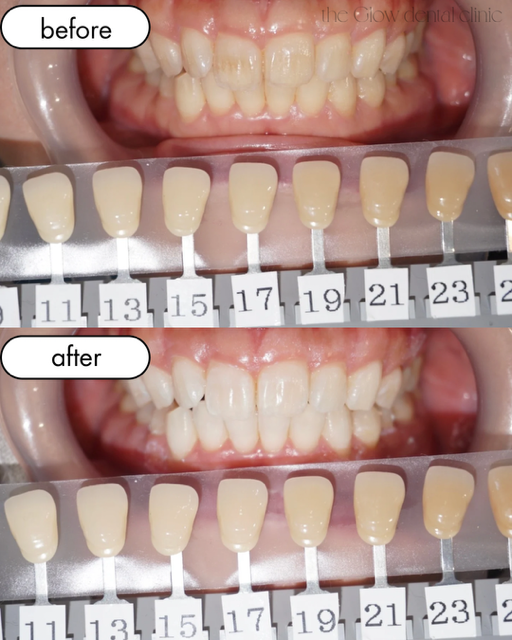 トランセントフラッシュ　1回症例⑤
