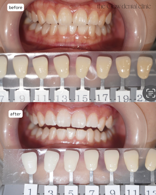 トランセントフラッシュ3回券症例④