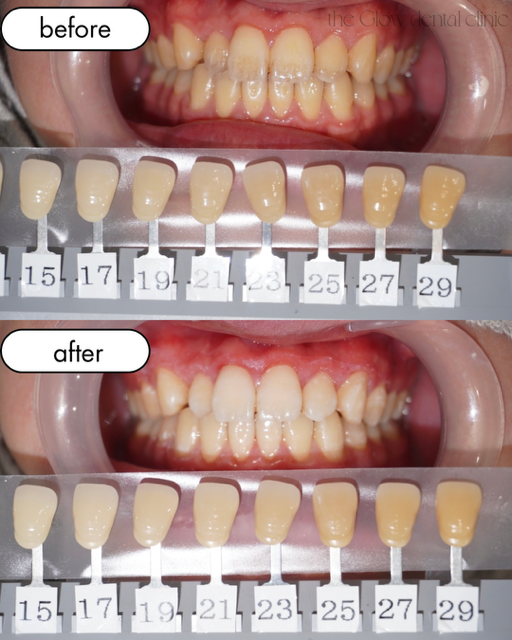 トランセントフラッシュ　1回症例④