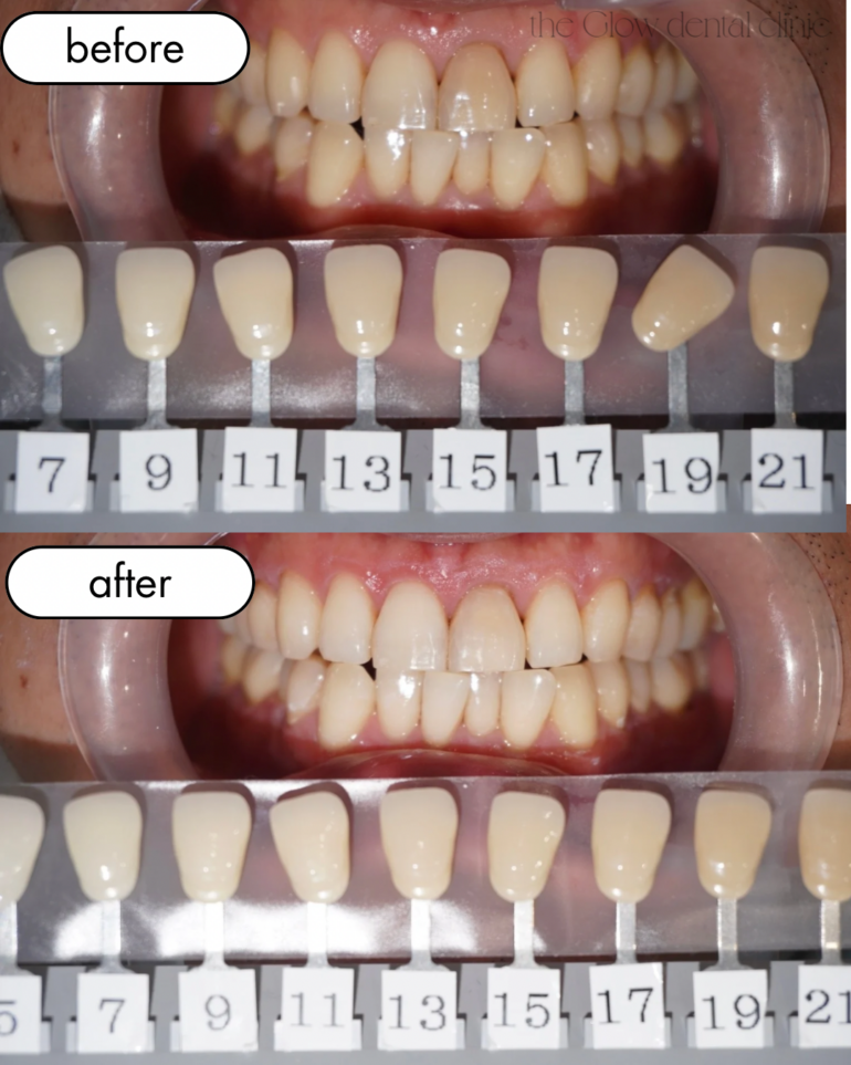 トランセントフラッシュ　1回症例⑥