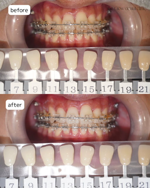 トランセントフラッシュ　1回症例➁