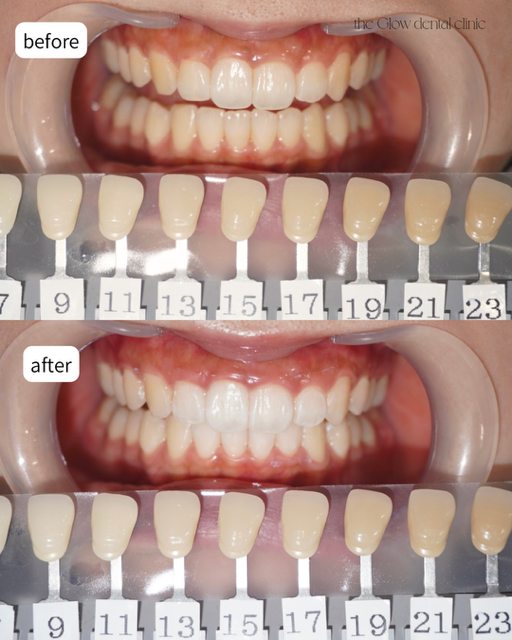 トランセントフラッシュ　1回症例①