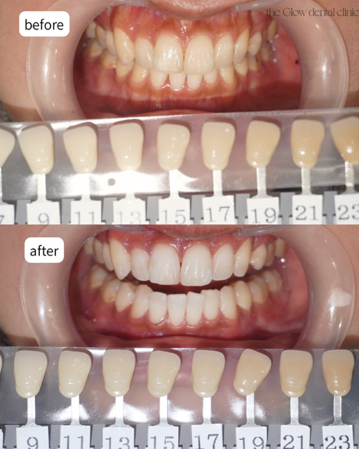 トランセントフラッシュ3回券症例
