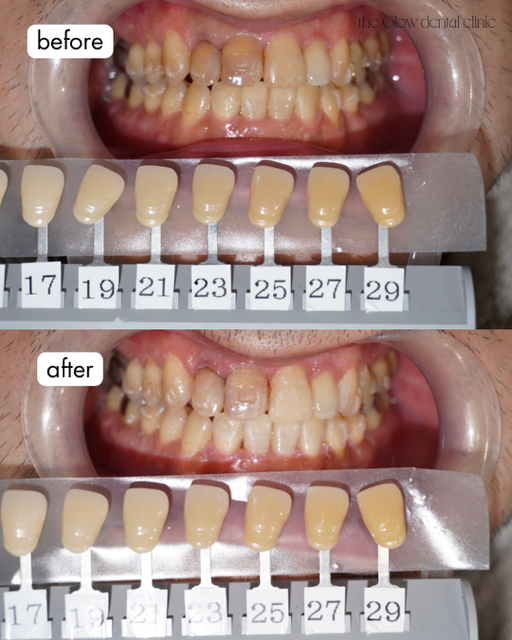 トランセントフラッシュ　1回症例③